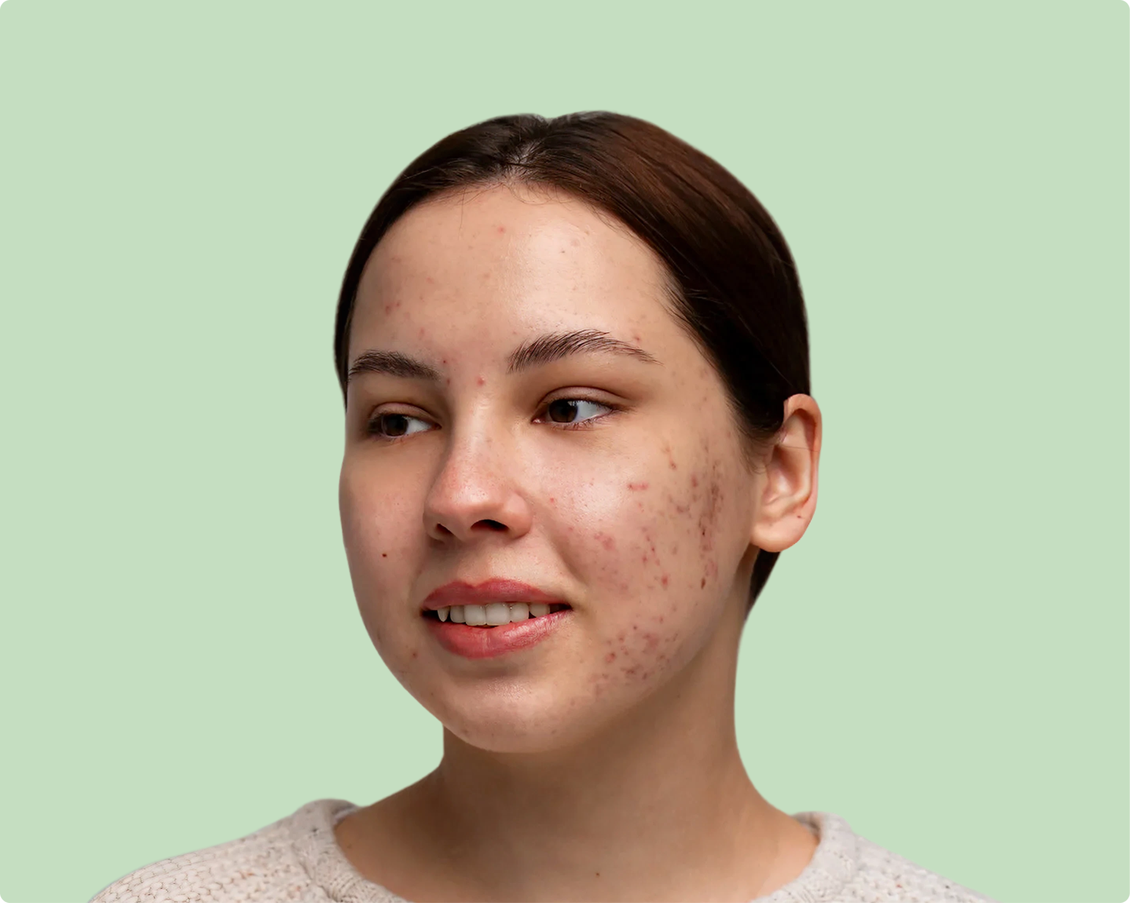 GloreSense before after acne treatment results Pakistani skin 21 days