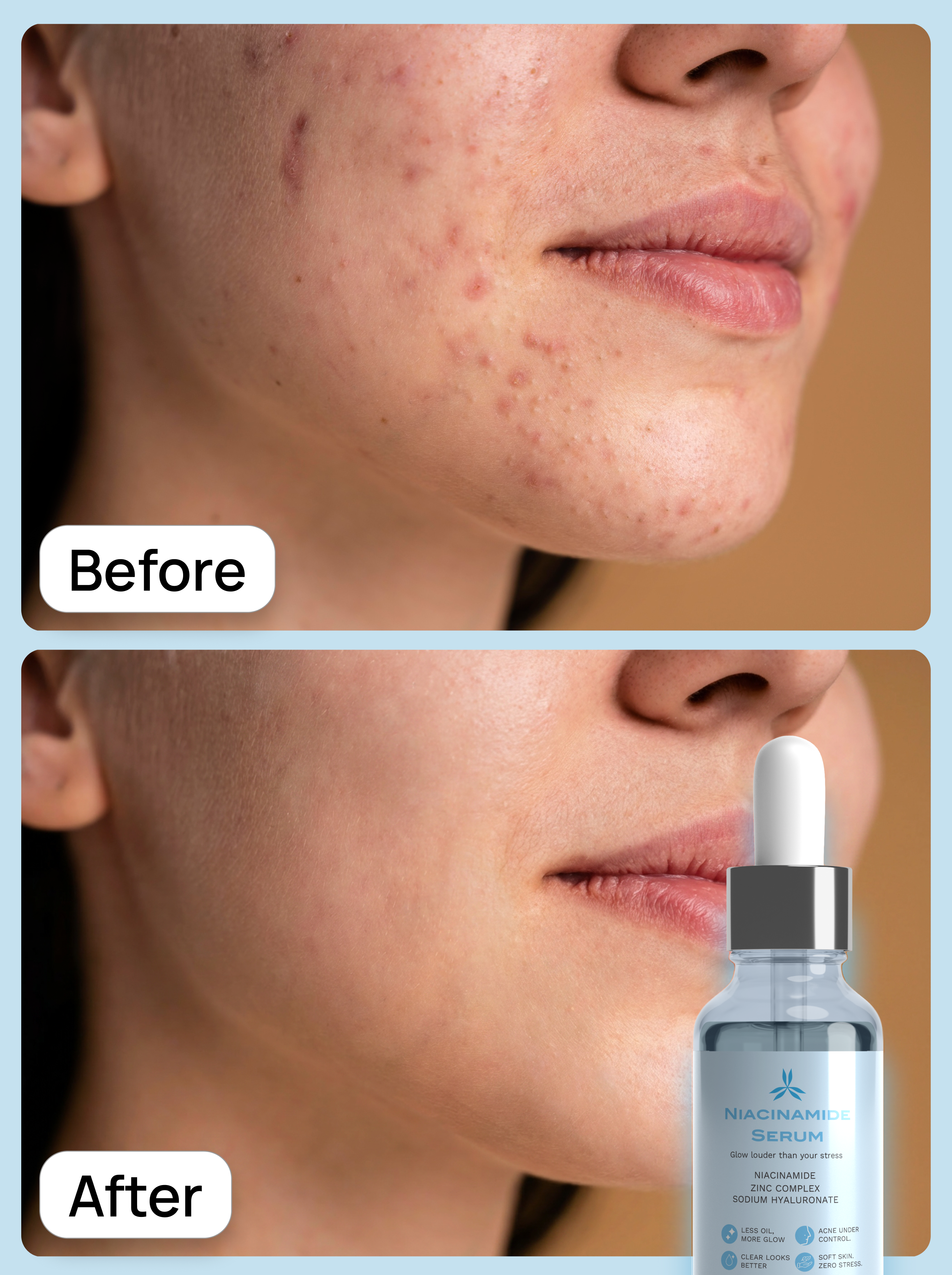 Before and after comparison of skin with acne treatment product shown.